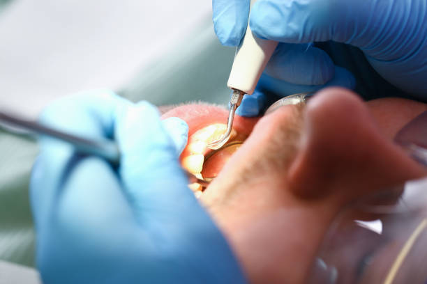 Best Emergency Dentist for Lost Fillings or Crowns in Greene, RI